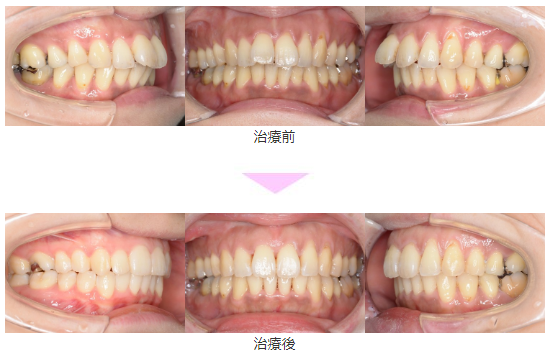 前歯のでこぼこ 叢生 インビザライン 非抜歯 治療期間1年1か月 川崎市 30代女性 世田谷区二子玉川で受けるマウスピース矯正 マウスピース矯正 専門サイト マウスピース矯正専門サイト