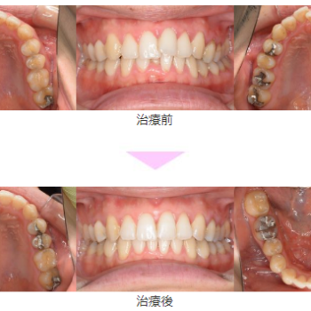 前歯の歯並びが悪い 叢生 インビザライン 非抜歯 治療期間11か月 横浜市 30代男性 世田谷区二子玉川 マウスピース矯正インビザライン マウスピース矯正専門サイト